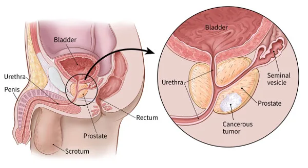 Prostate Cancer Treatment in BHCC