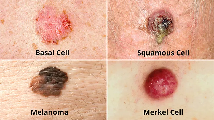 Skin Cancer Treatment
